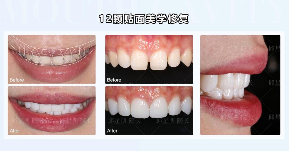 美学修复和正畸哪个好？如何根据需求选择更合适？-图1