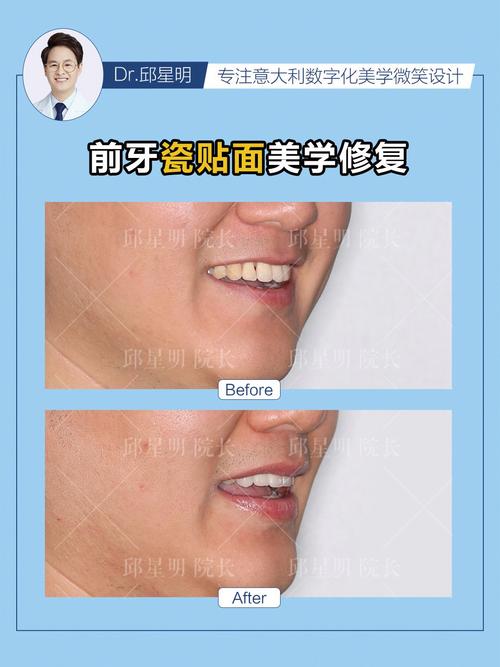 美学修复和正畸哪个好？如何根据需求选择更合适？-图2