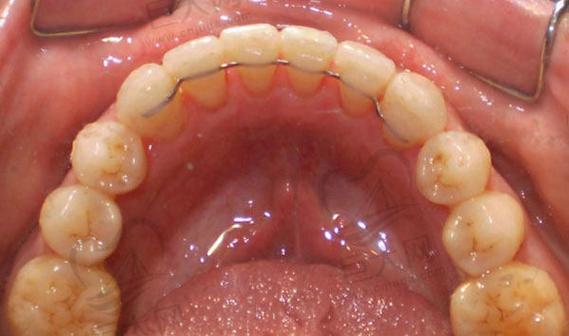 舌侧固定保持器正畸期间具体怎么护理？-图1