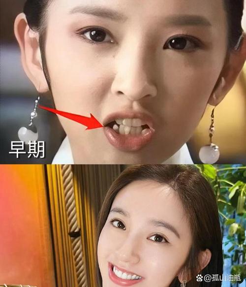 明星正畸前后对比照，颜值逆袭的真相是什么？-图1