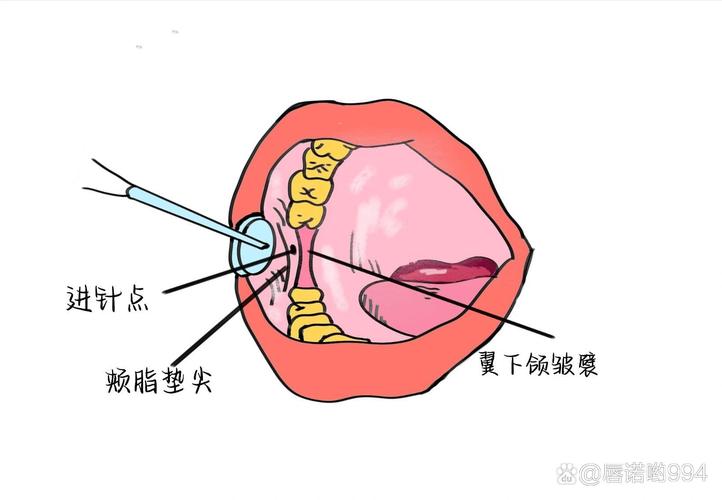 牙科打麻药是怎么打的？具体方法步骤是什么？-图2