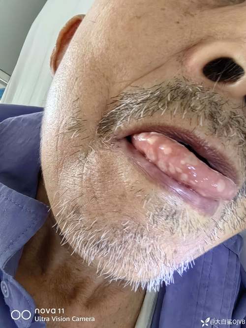 正畸牙齿带环后口腔溃疡频发怎么办？-图1