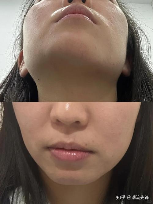 正畸后为何会出现颞颌关节紊乱问题？-图2