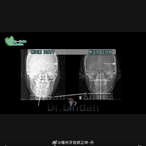 正畸后为何会出现颞颌关节紊乱问题?-图3 正畸后为何会出现颞颌关节紊乱问题?-图3