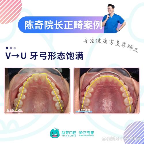 口腔正畸偏颌容易复发-图2