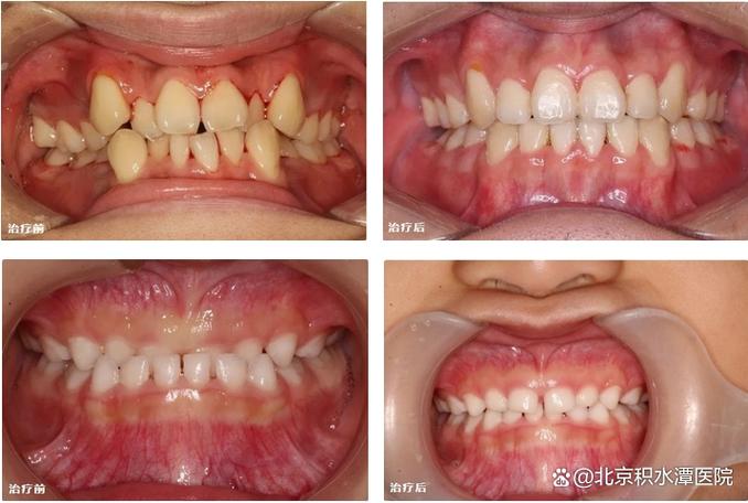 口腔正畸偏颌容易复发-图3