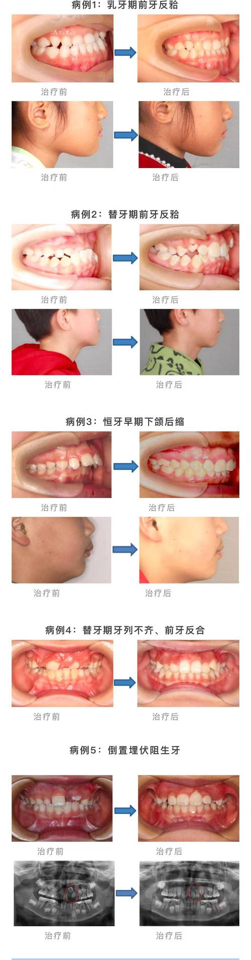口腔正畸偏颌容易复发-图1