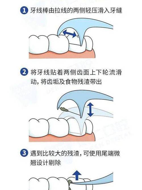 口腔内拆线怎么拆才正确？拆线后要注意什么？-图2