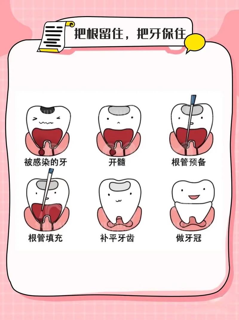 牙髓腔有哪些常用的临床治疗方法？-图2