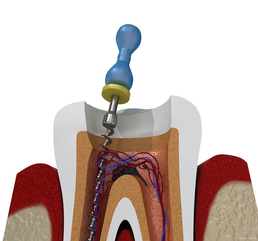 牙髓腔有哪些常用的临床治疗方法？-图1