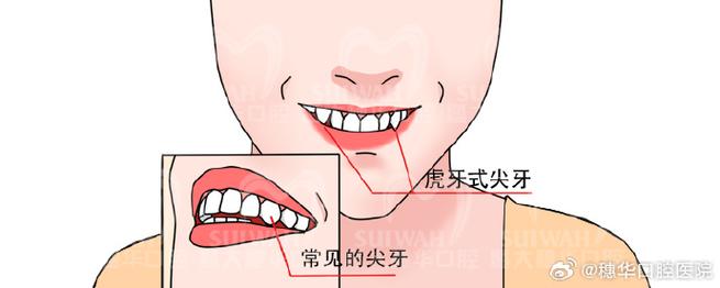 正畸尖牙中性关系标志-图3 正畸尖牙中性关系标志-图3