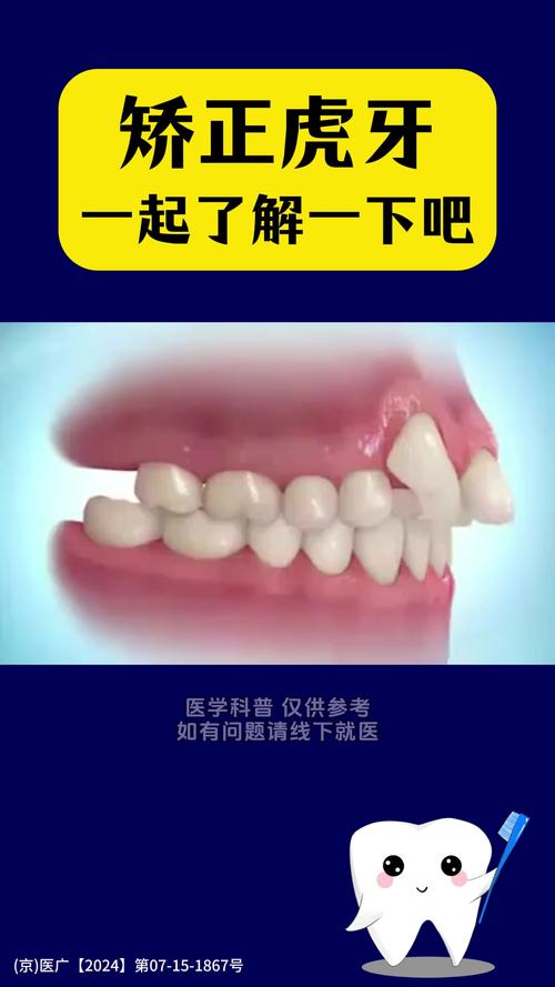 虎牙矫正有哪些常用矫正方法?-图3 虎牙矫正有哪些常用矫正方法?-图3