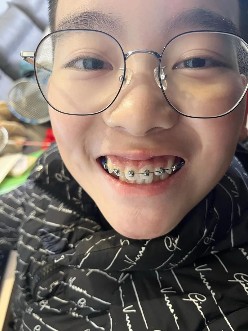 虎牙矫正有哪些常用矫正方法？-图2
