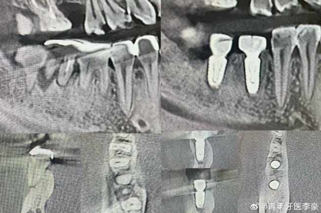 种牙材料会影响核磁共振检查吗？-图1