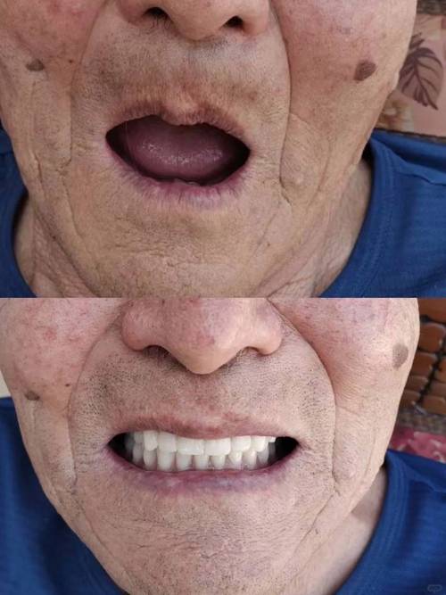 满口无牙做种植牙，究竟需要种几颗才合适？-图1