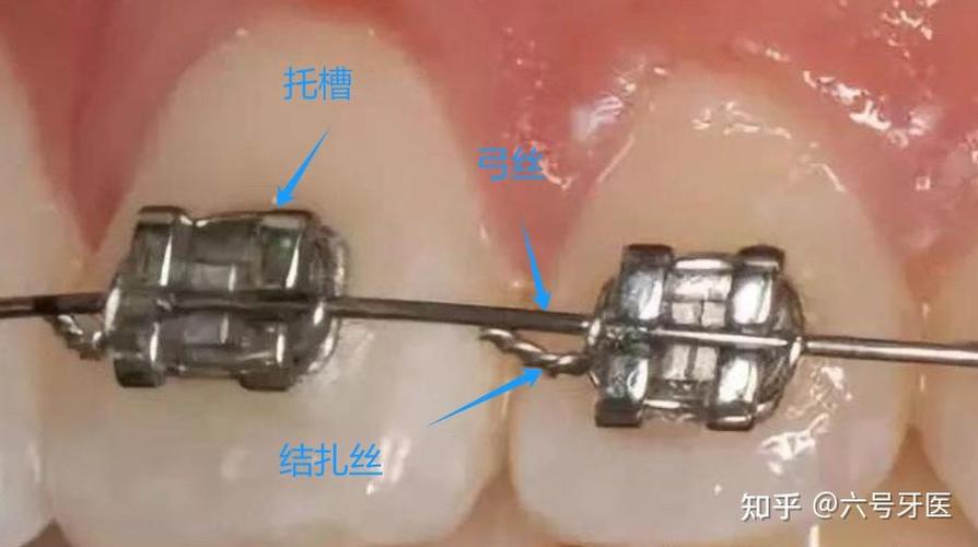 正畸托槽粘接位置错误-图3