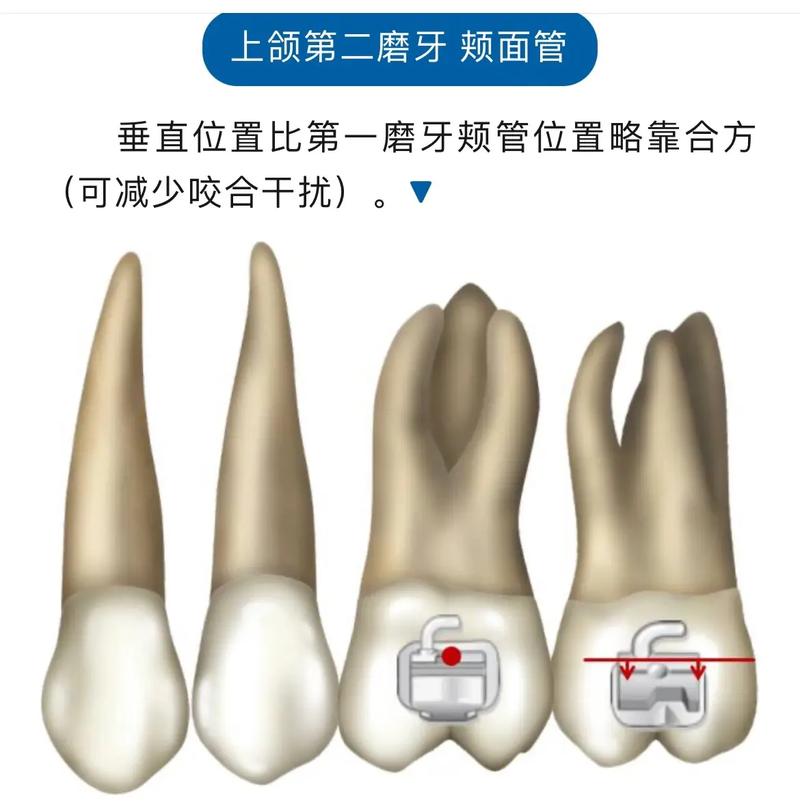 正畸托槽粘接位置错误-图2