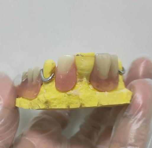 如何掌握临时义齿制作的核心方法与注意事项？-图2