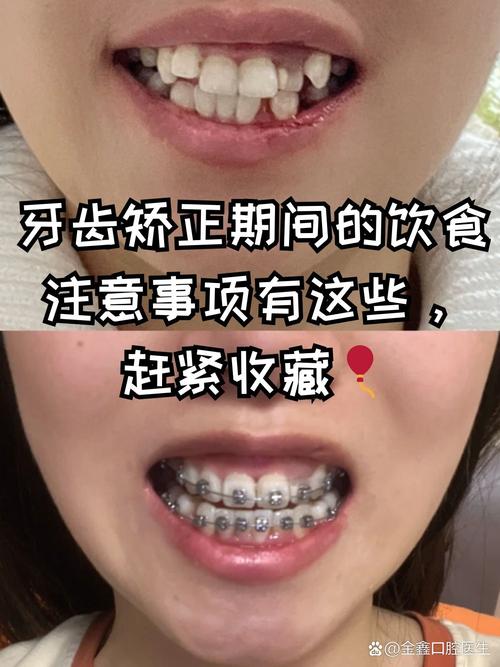 牙齿不齐必须正畸吗？不矫正会有什么影响？-图3