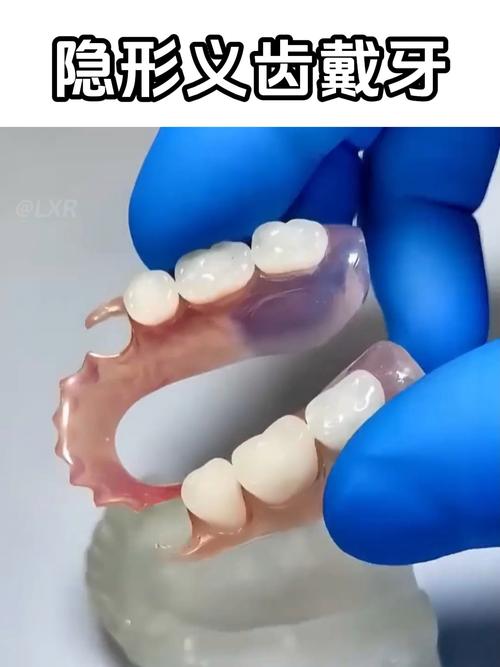 隐形义齿铸道方法-图2