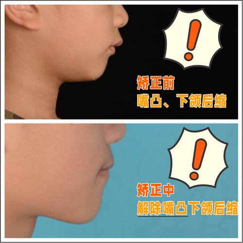 唇倾下前牙的方法有哪些？如何有效实施？-图1