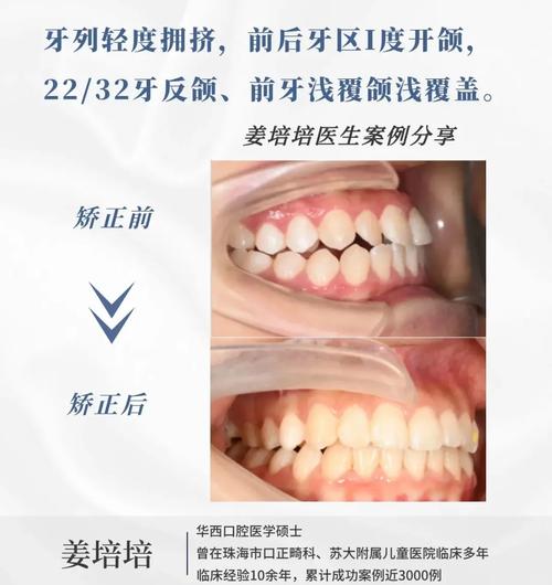 唇倾下前牙的方法有哪些？如何有效实施？-图3