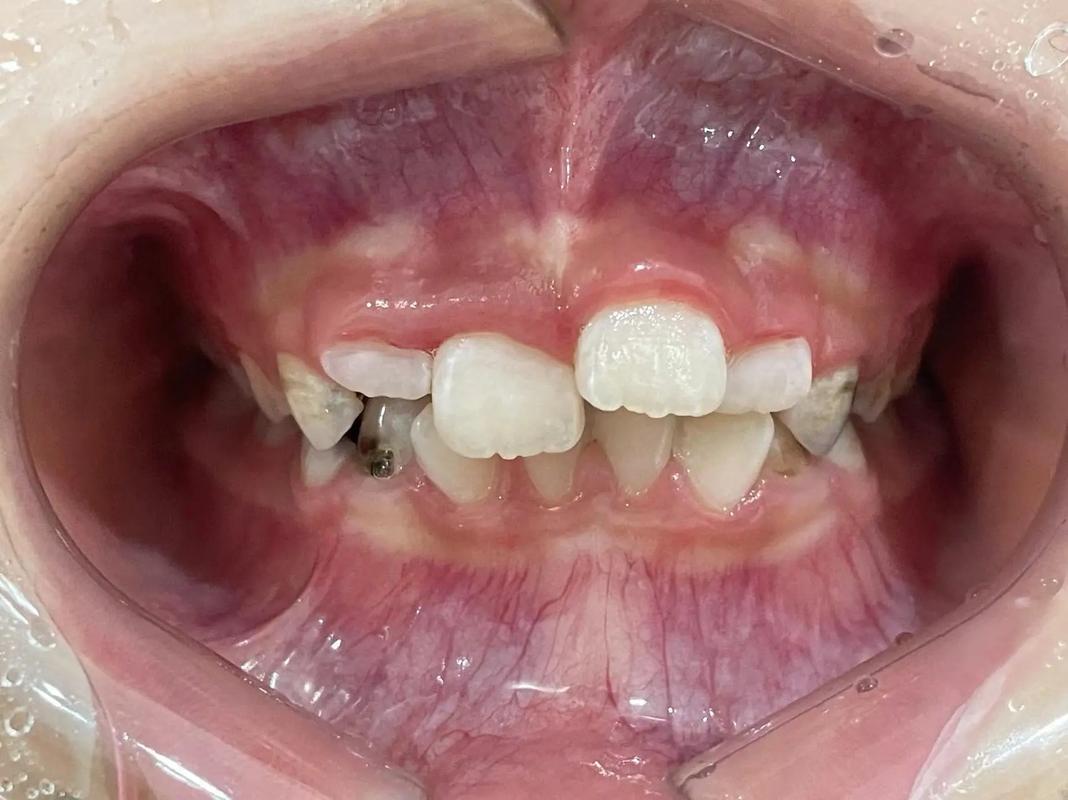 正畸治疗真的会导致牙齿提早脱落吗？-图2