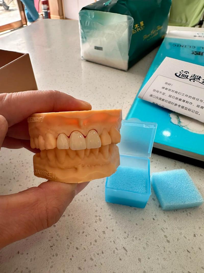 烤瓷冠试戴的正确方法有哪些？-图2