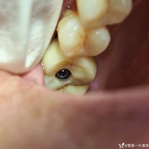 种牙螺丝固位疼不疼？过程有痛感吗？-图1