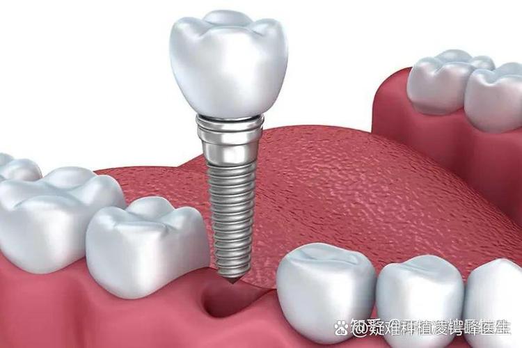 种牙螺丝固位疼不疼？过程有痛感吗？-图2