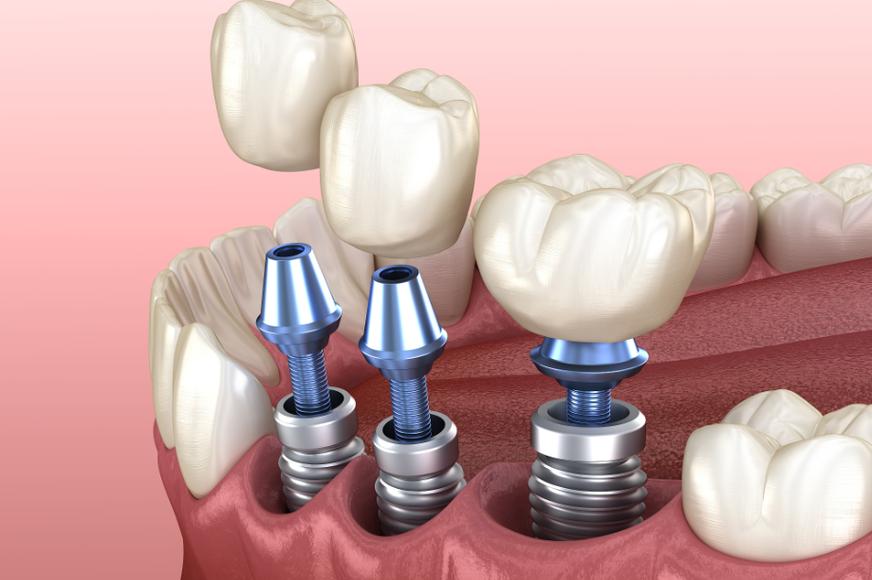 种牙期间健身会影响种植效果吗？-图2