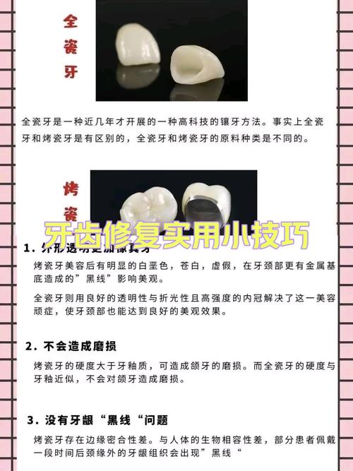 烤瓷牙与种植牙如何选？哪种更适合长期使用？-图2