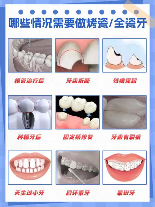 烤瓷牙与种植牙如何选？哪种更适合长期使用？-图1