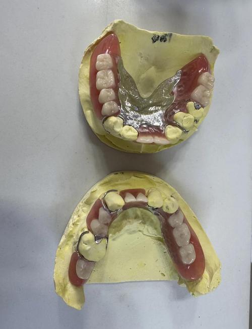 活动义齿软衬方法如何选择与应用？-图1