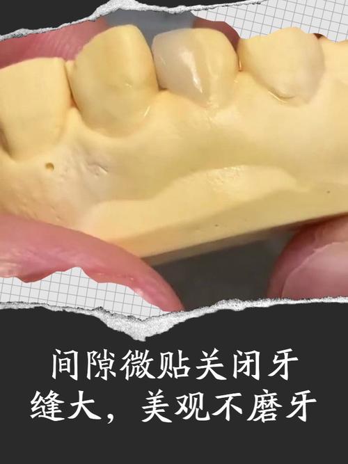 正畸磨牙近移间隙关闭，如何高效精准实现？-图2