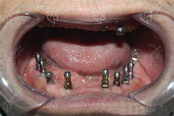 半口牙没了种植牙怎么种？-图3