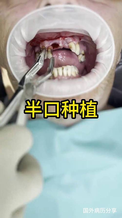 半口牙没了种植牙怎么种？-图2