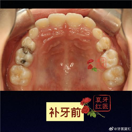 儿童后牙充填方法-图1