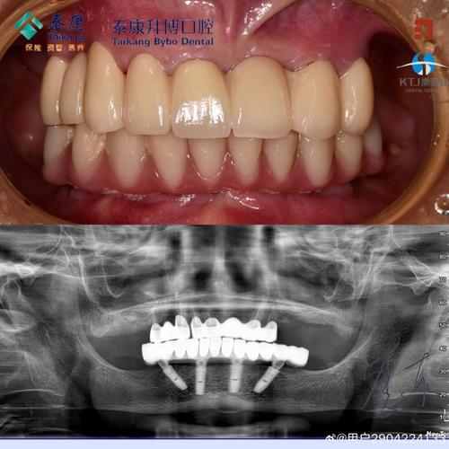 拜博口腔种牙活动能省多少种植费用？-图3