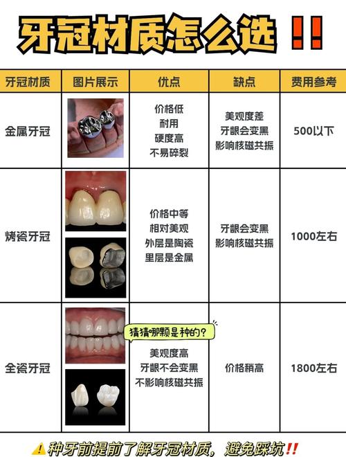 种牙牙冠材质哪种更好？如何选择适合自己的？-图1