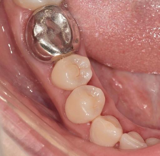 种牙牙冠材质哪种更好？如何选择适合自己的？-图2