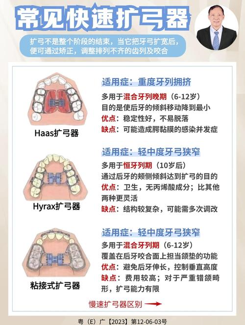 儿童正畸扩弓方法有哪些？哪种更适合孩子？-图2