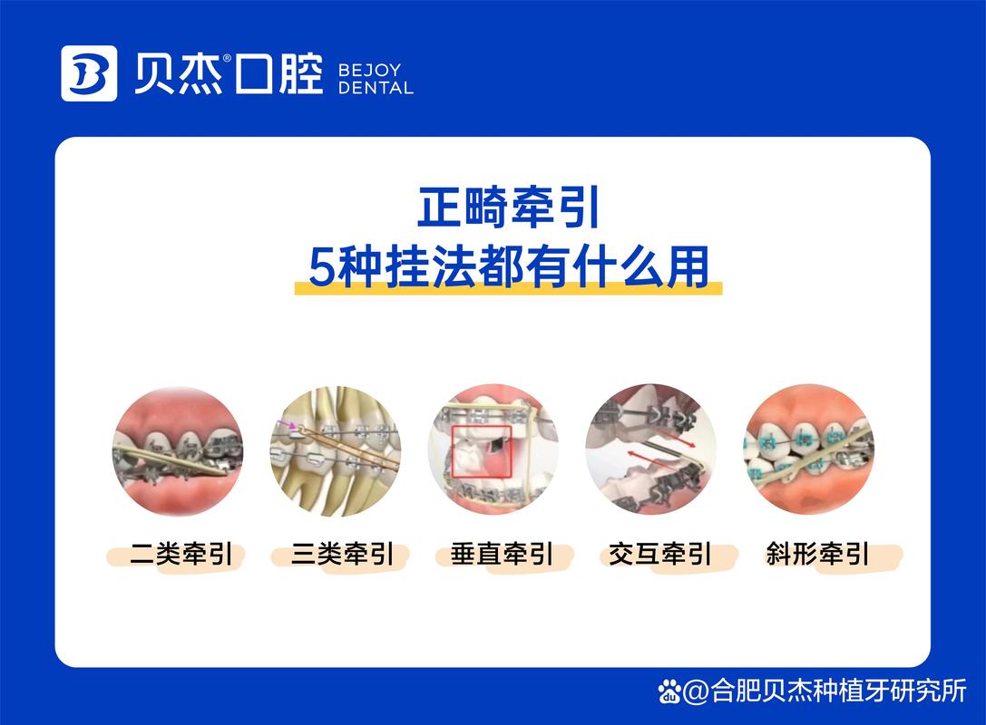 正畸悬吊结扎如何操作？关键步骤与技巧解析-图3