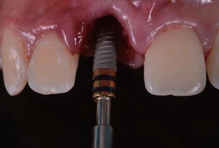 西安微创即刻种牙效果如何？即刻种牙安全吗？-图2