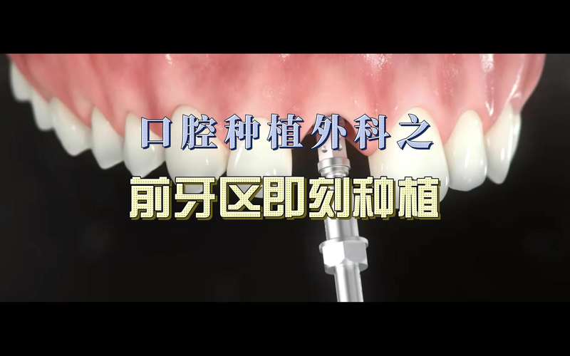 西安微创即刻种牙效果如何？即刻种牙安全吗？-图3