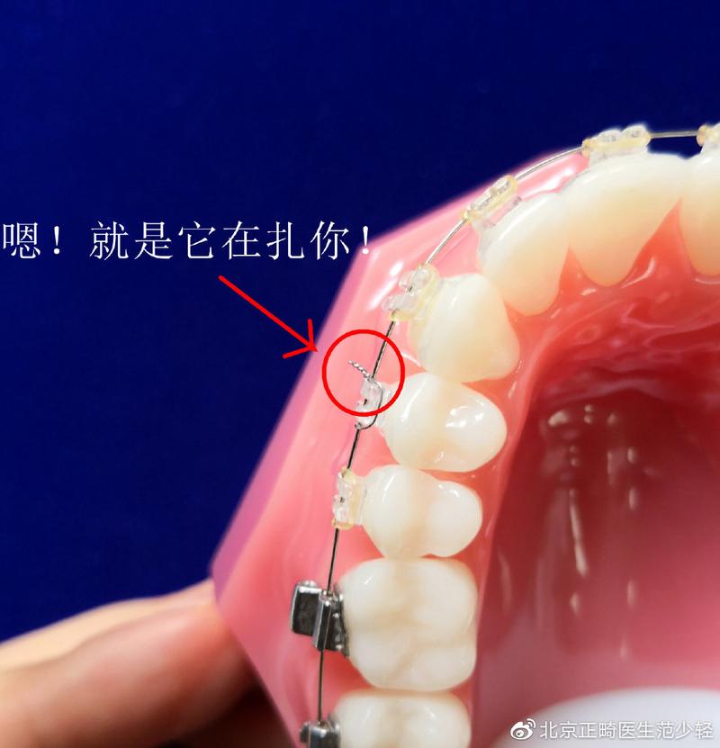 正畸上结扎丝方法-图1