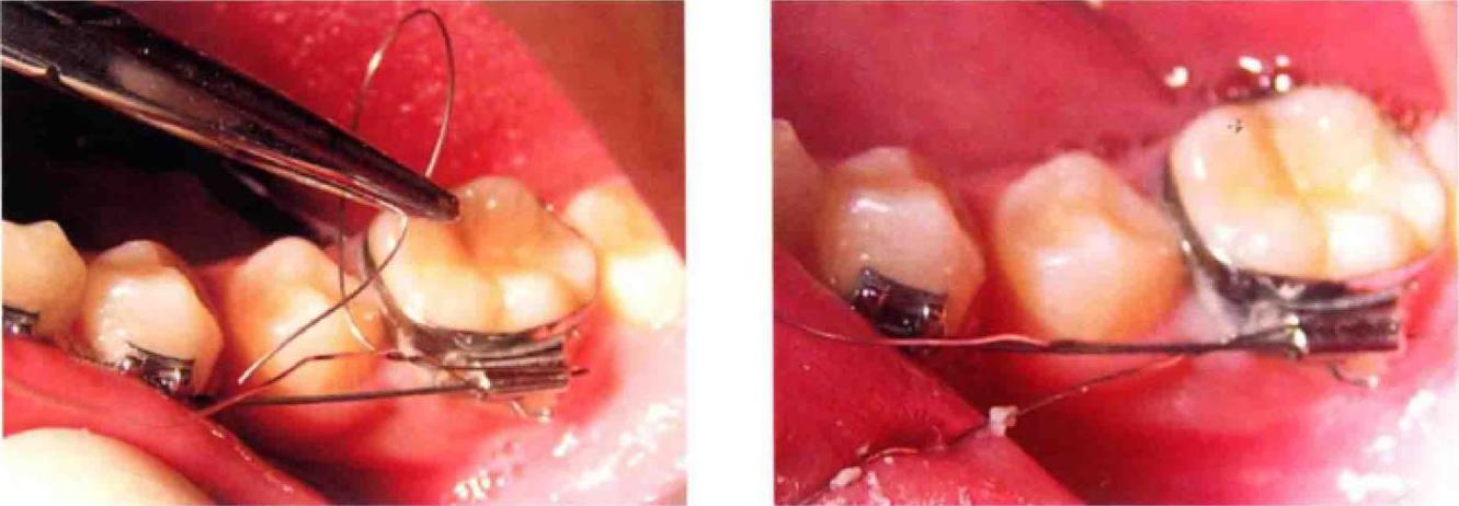 正畸上结扎丝方法-图3