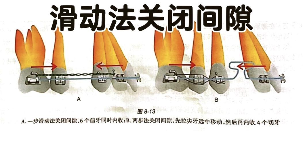 正畸如何有效关闭切牙间隙？具体方法有哪些？-图1