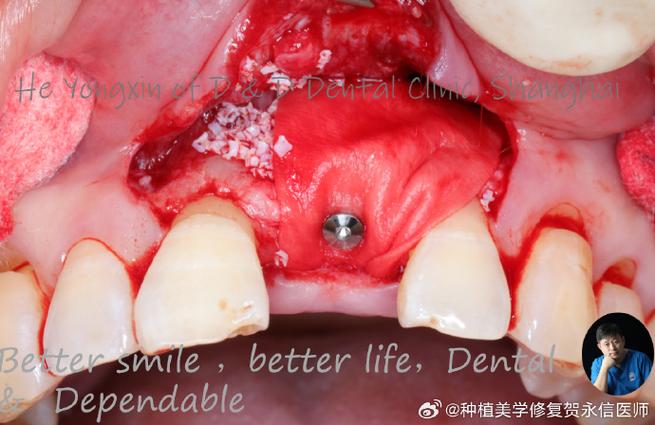 种牙前增骨有必要吗？为何不能直接种植？-图1
