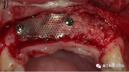 种牙钛网一般多久需要取出？术后恢复要注意什么？-图2